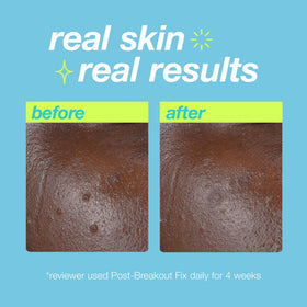 Dermalogica Clear Start Post-Breakout Fix ready for night use with hydrating feel.