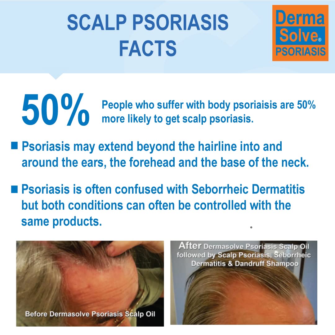 Dermasolve Scalp Psoriasis Conditioner bottle 8oz 2-pack on shelf for hydration.