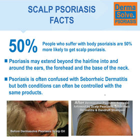 Dermasolve Scalp Psoriasis Conditioner bottle 8oz 2-pack on shelf for hydration.