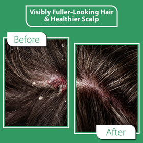 DERMOIA applying-serum-to-scalp demonstrates easy, fast-absorb relief.