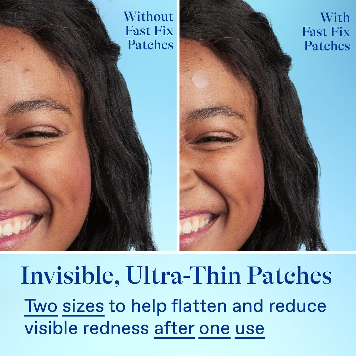 Hydrocolloid patch absorbs fluids to reduce visible impurities around blemishes.