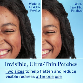 Hydrocolloid patch absorbs fluids to reduce visible impurities around blemishes.