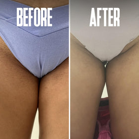 Divine Derriere pads on bikini area promote smoother skin after hair removal.
