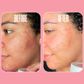 Divine Derriere pads face application shows gentle cleansing and texture improvement.