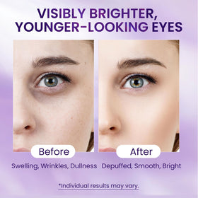 Doracome eye-area depuffing closeup suggesting potential swelling reduction.