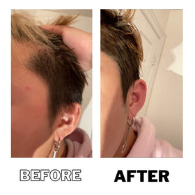 DPERM long-lasting results after a single treatment