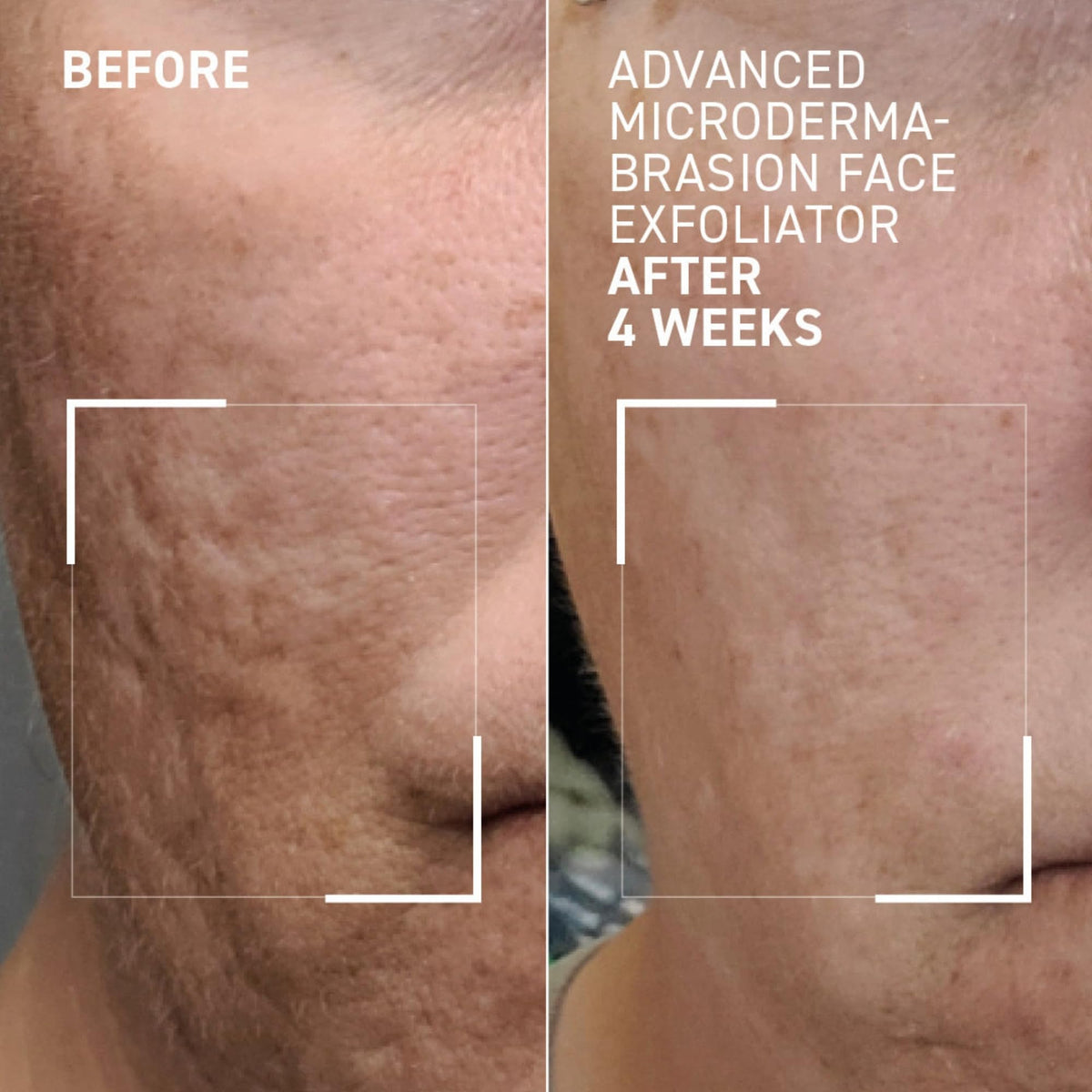 Dr. Brandt Skincare exfoliator applied on damp skin for even texture.