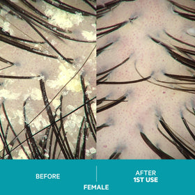 DS Laboratories Dandrene application on scalp demonstrates exfoliating action.