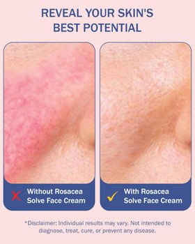 e70 rosacea serum in morning routine on clean skin