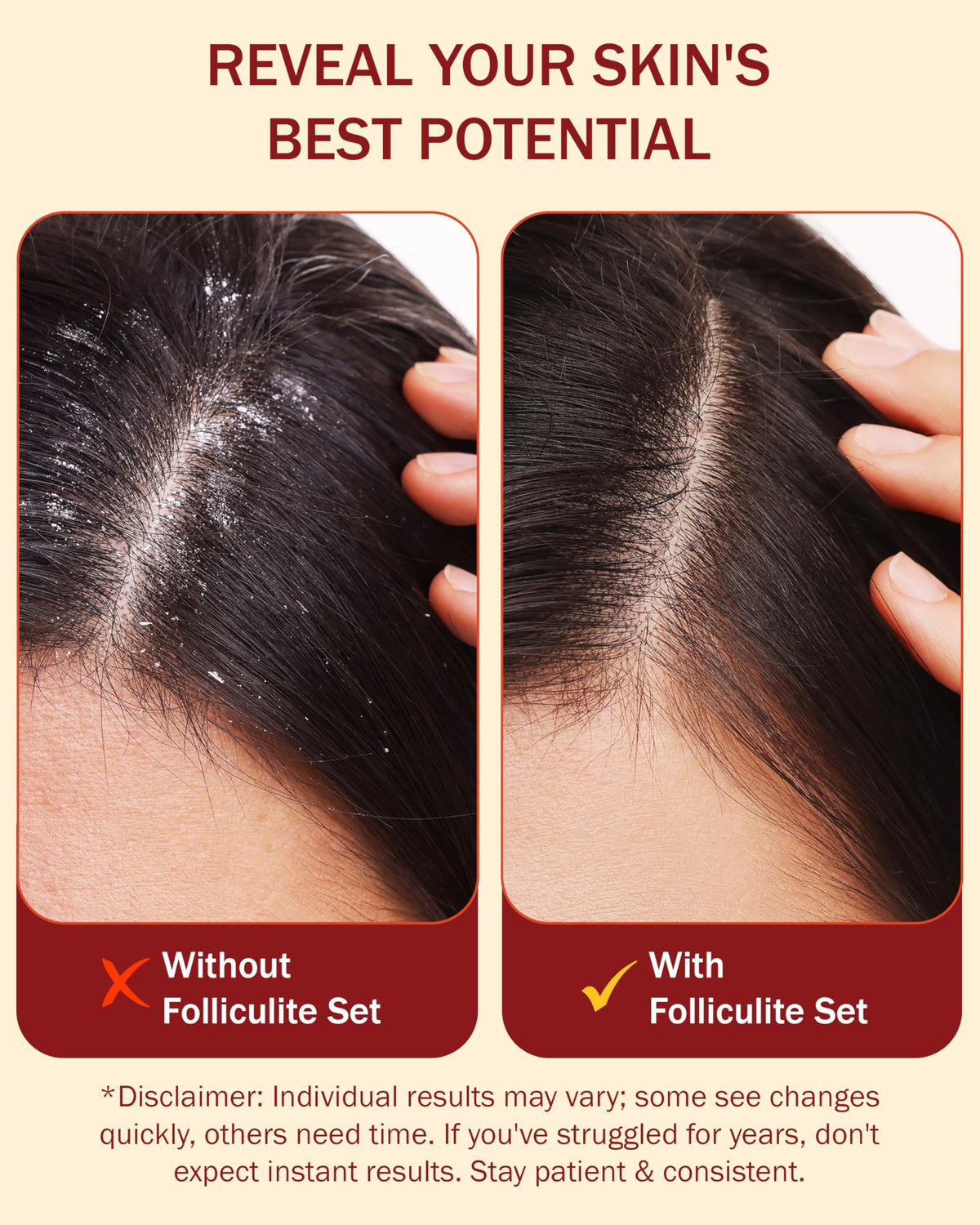 e70 salicylic acid 3% bottle label communicates active ingredient for buildup relief