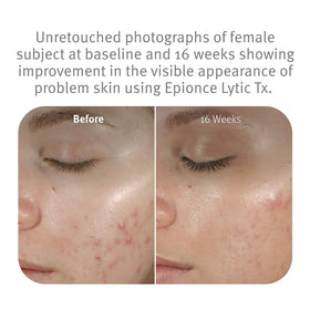 Epionce Lytic Tx blemish clarity visual suggesting reduced appearance.