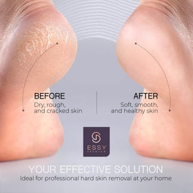 Essy safety technology pressure lock auto-stops to protect skin