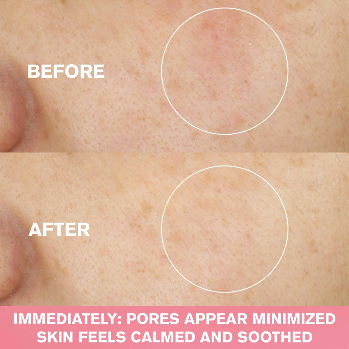 Application view of Nutritious wash for pore refinement.
