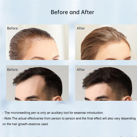Exfyery Derma Roller lightweight construction ideal for daily home use.