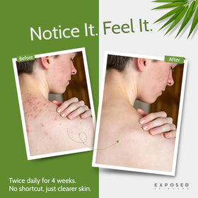Exposed Skin Care bacne wash foam-lather showing rich bubbles for back and chest cleansing