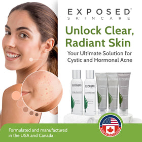 Exposed Skin Care spot-treatment tiny bottle focuses blemishes effectively.