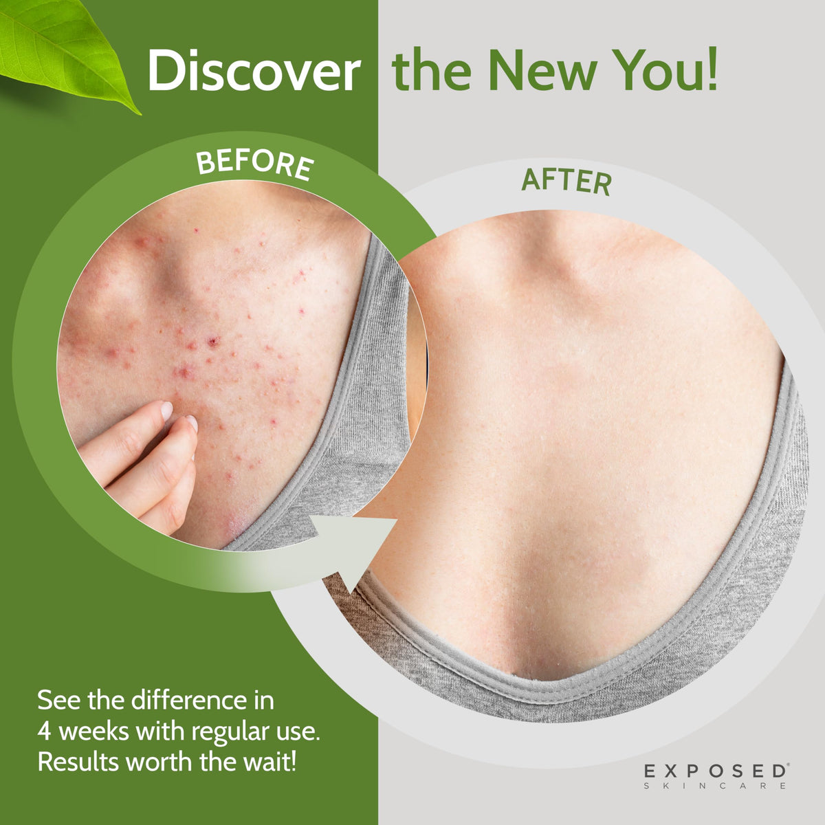 Exposed Skin Care tea tree oil closeup highlighting natural ingredient and refreshing cleanse