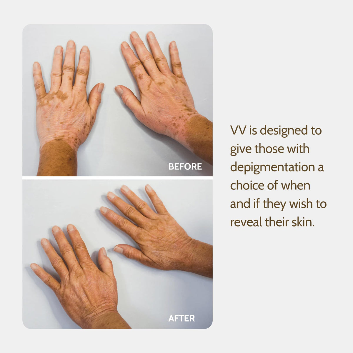 Fake Bake Vitiligo Vanquish application on the face shows easy, full-face use