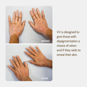Fake Bake Vitiligo Vanquish application on the face shows easy, full-face use