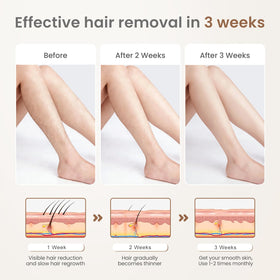 FELOOW S3 energy settings five levels for skin type flexibility