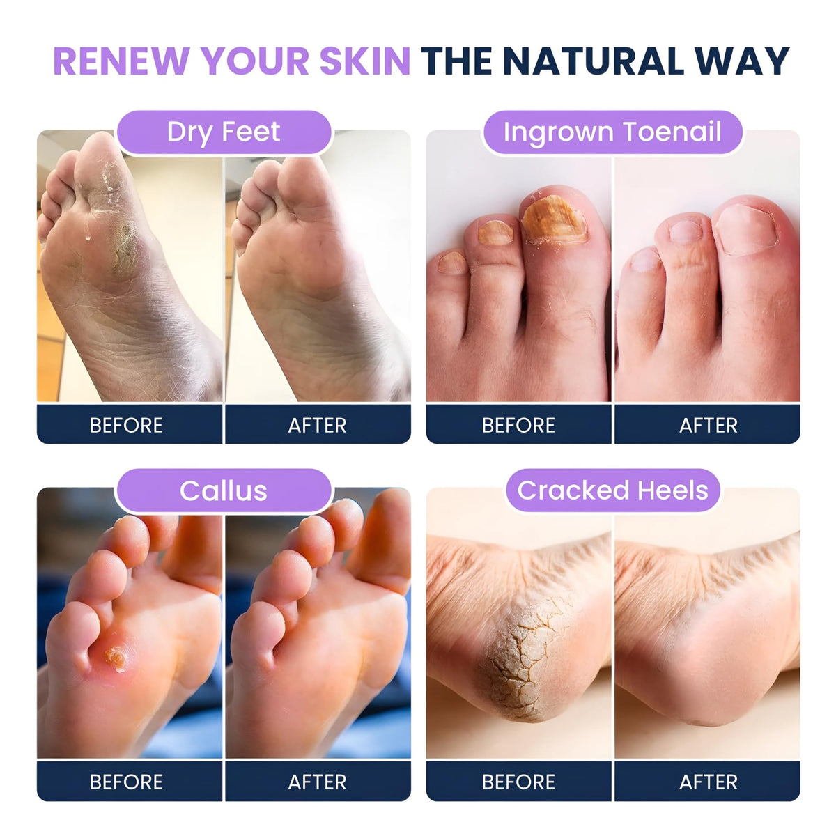Foot Cure Close-up of hydrated feet after a mineral-rich soak.