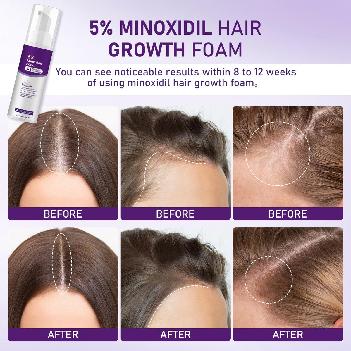 Fugit minoxidil foam women scalp contact demonstrating gentle massaging action.