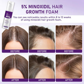 Fugit minoxidil foam women scalp contact demonstrating gentle massaging action.