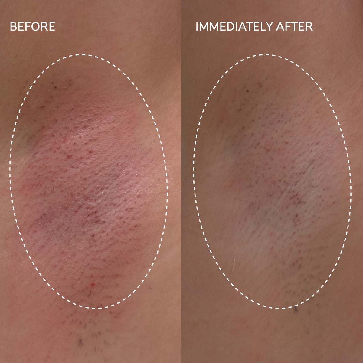 Underarm area shown being treated with Fur Flash Repair Gel.