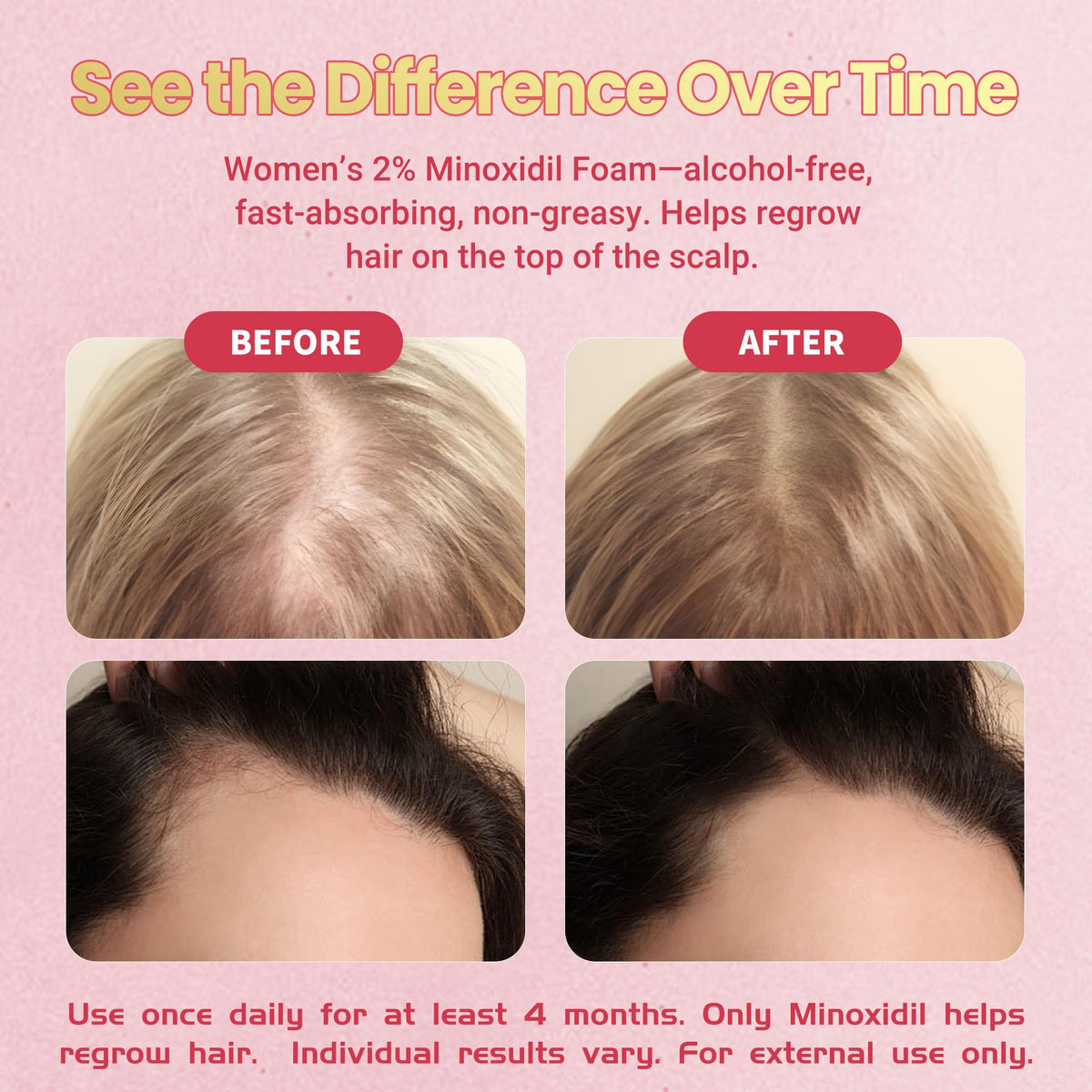 Gemächlich Zu Hause Minoxidil Foam crown area focus suggests targeted regrowth at thinning zones.