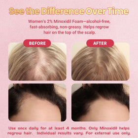 Gemächlich Zu Hause Minoxidil Foam crown area focus suggests targeted regrowth at thinning zones.