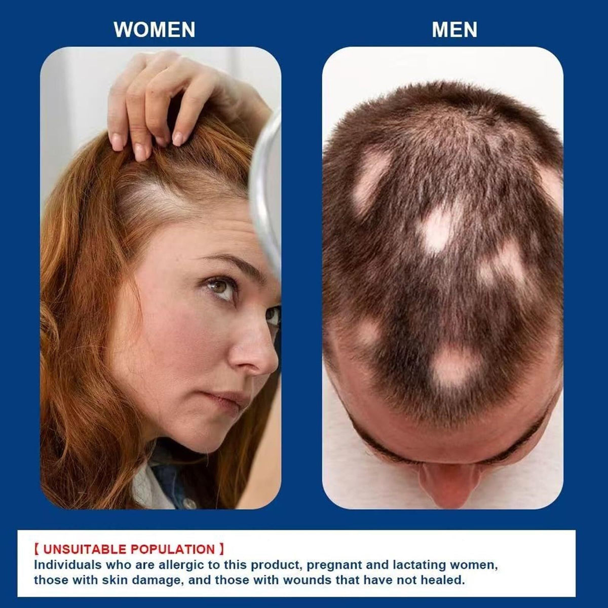 Generic Alopecia Hair Growth Cream closeup highlights creamy texture