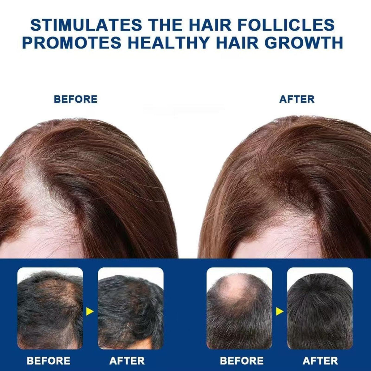 Generic Alopecia Hair Growth Cream daily-use bottle ready for routines