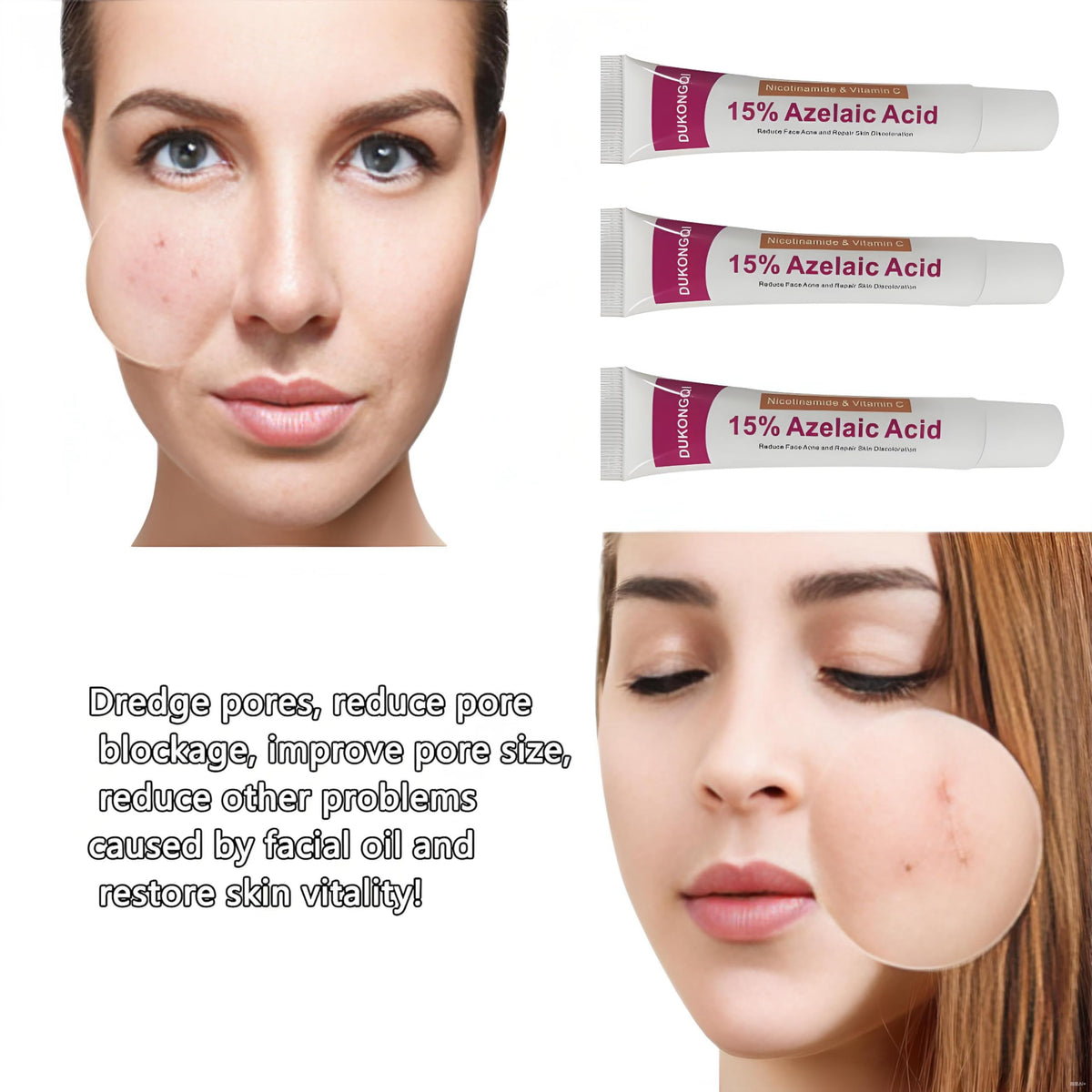 Packaging of Generic Azelaic Acid Cream ideal for daily skincare routines.
