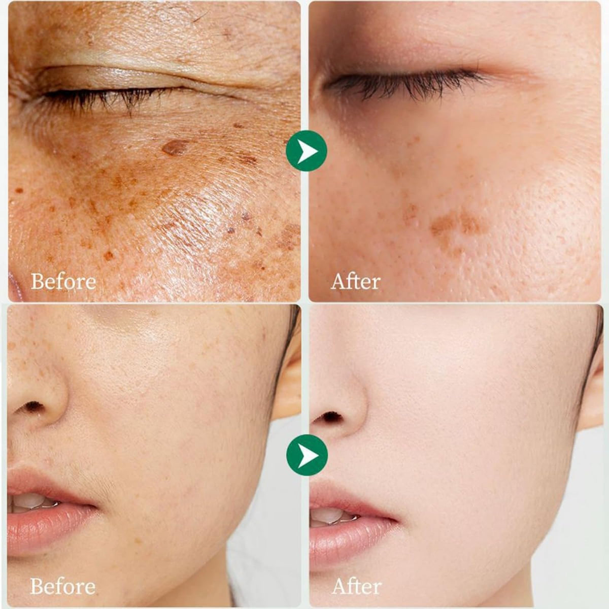 Underarms treated with Generic Dark Spot Cream for gentle care