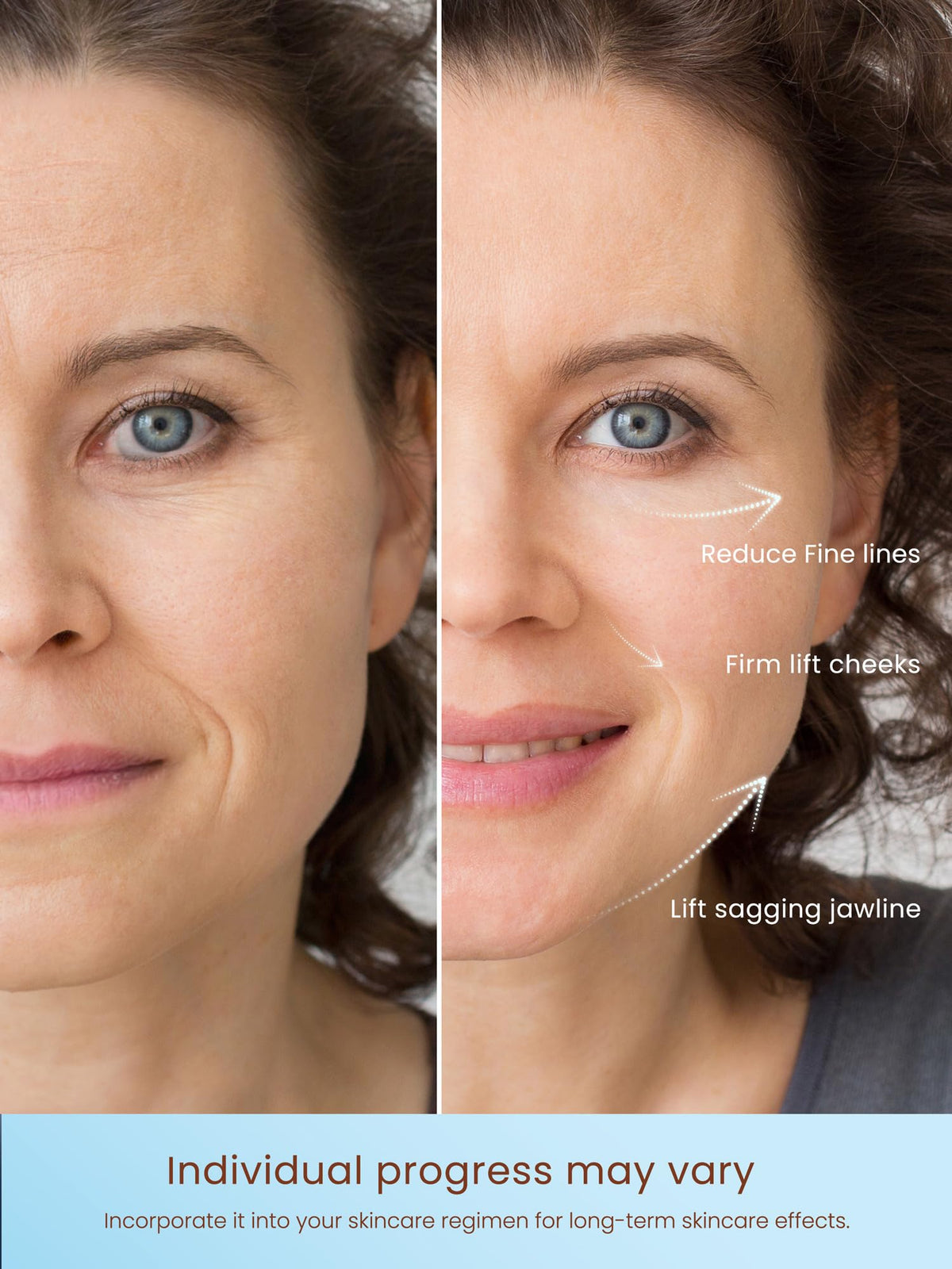 Generic RF wand used for skin tightening around the cheeks and jawline