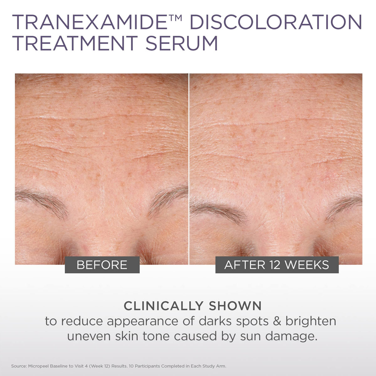 Before and after view of dark spots with Glytone treatment