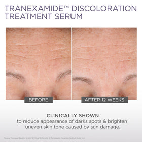 Before and after view of dark spots with Glytone treatment