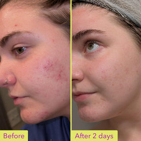 Good Molecules azelaic acid treatment pack shot shows travel-friendly packaging