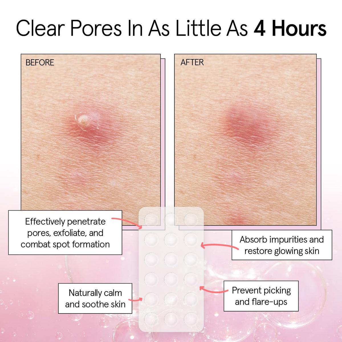 Grace & Stella patches infused with tea tree oil for blemish care