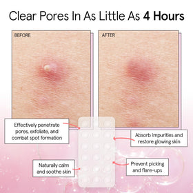Grace & Stella patches infused with tea tree oil for blemish care
