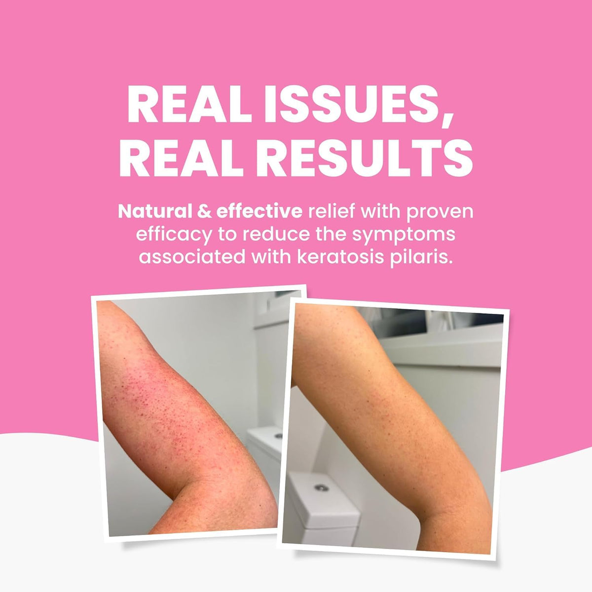 Grahams Natural KP Cream hydrates dry skin with urea and niacinamide