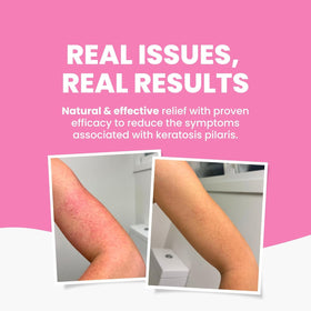 Grahams Natural KP Cream hydrates dry skin with urea and niacinamide