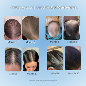 Growplex Complex10 capsules bottle showing daily hair nutrition support.
