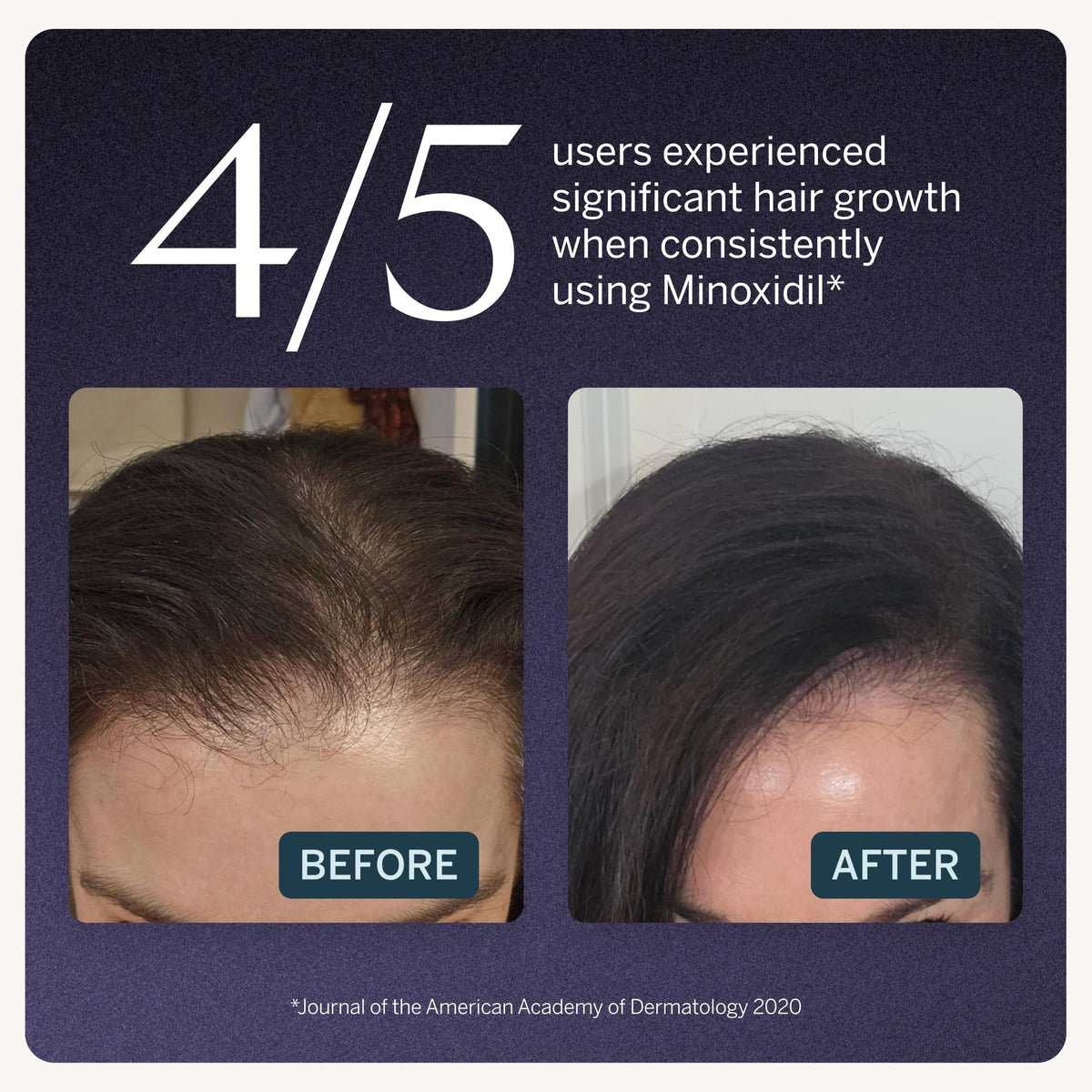 Happy Head Minoxidil 2% women precision dropper applying serum to thinning areas.