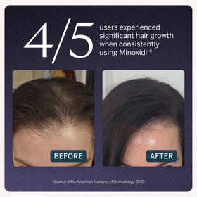 Happy Head Minoxidil 2% women precision dropper applying serum to thinning areas.