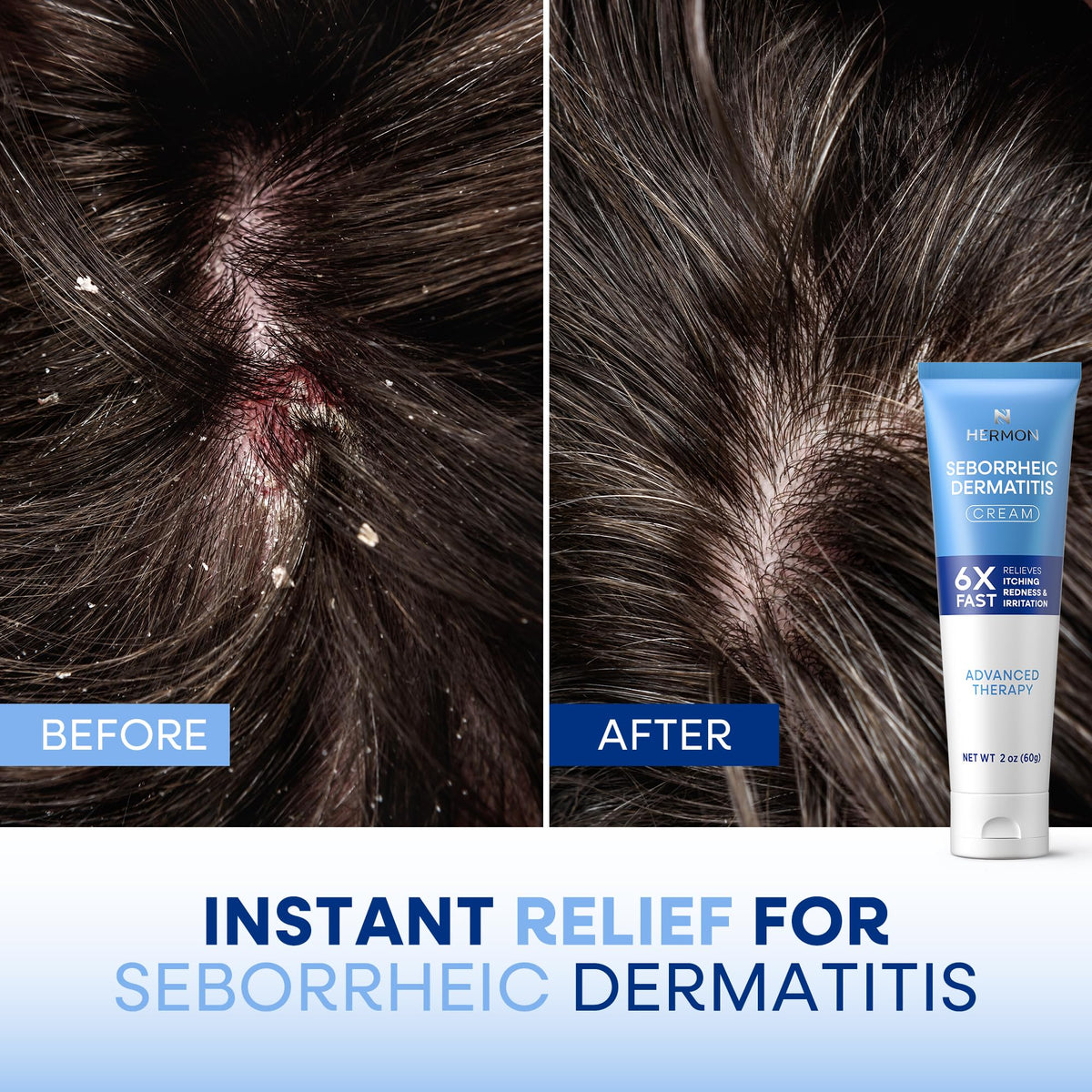 Hermon cream used on chest and body areas