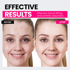 Hunvva EP-300 treatment on face and neck to shape contours.