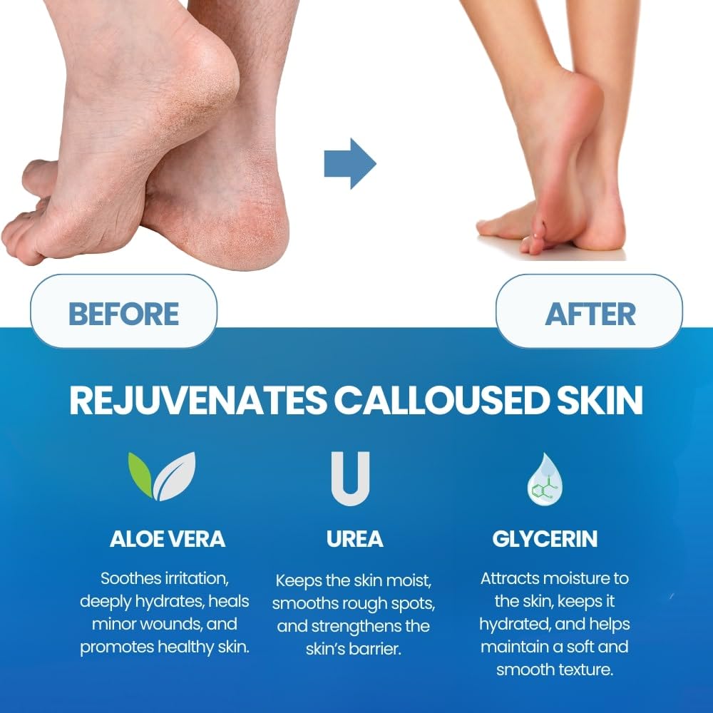 Imperial Feet dry cracked heels treatment improves foot softness.