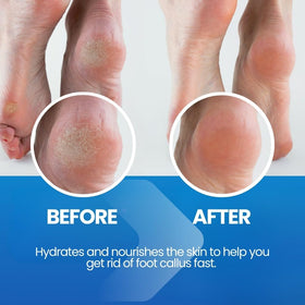 Imperial Feet rough heel softening for smoother walking.