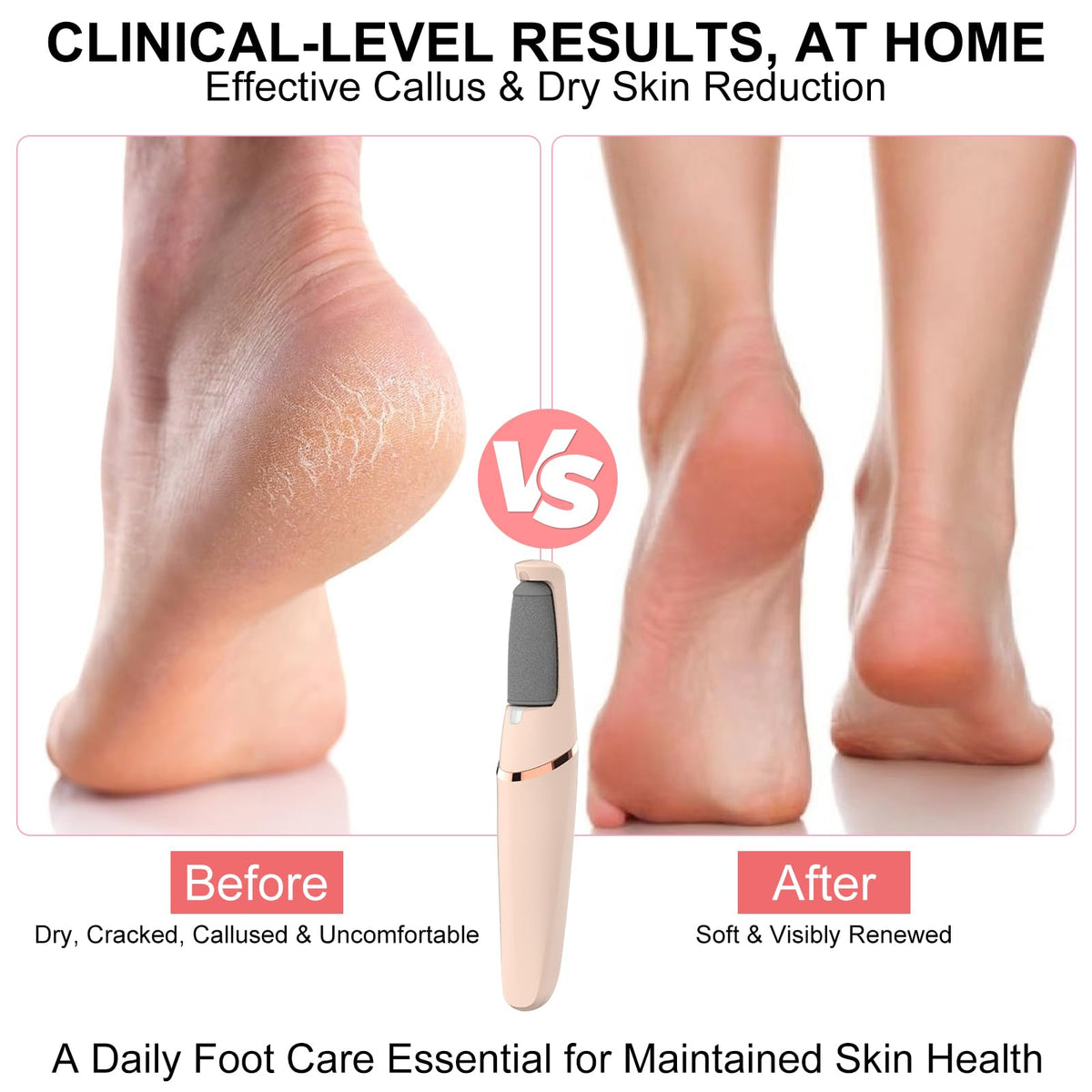 Innoflyx coarse-head callus remover for fast rough skin reduction